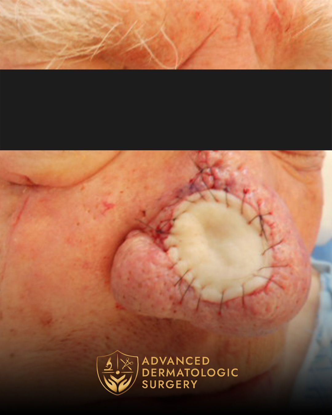Reconstructive surgery on the nose after Mohs surgery at Advanced Dermatologic Surgery