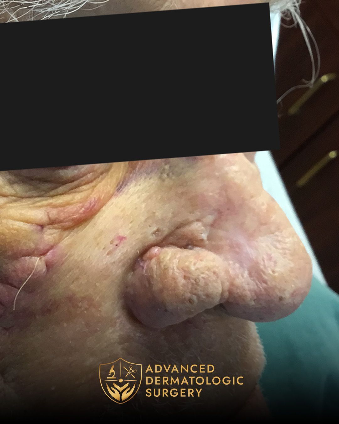 Mohs surgery of 