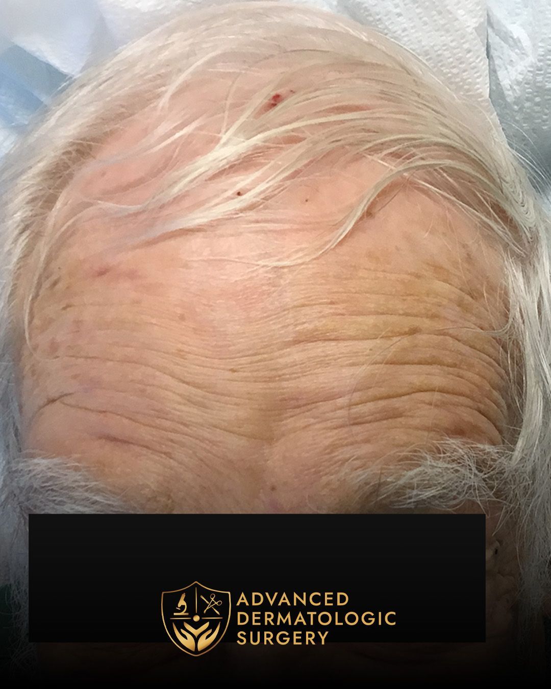 Close up of long term results on a man's forehead after Mohs surgery at Advanced Dermatologic Surgery