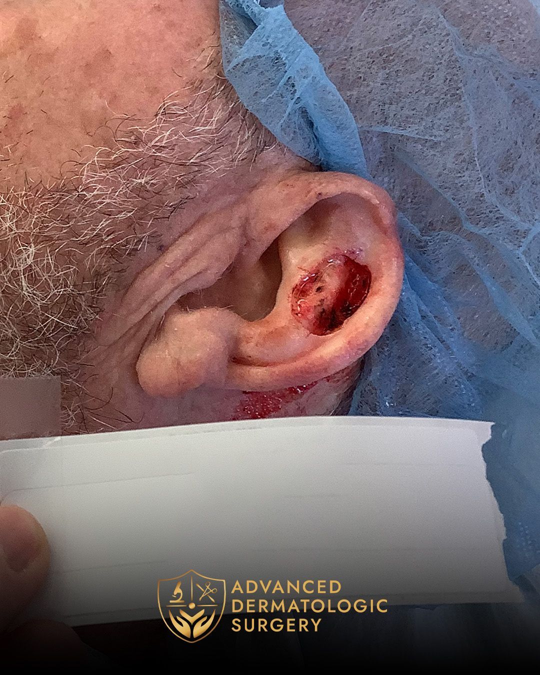 Close up of a pre operative surgery on a man's ear for Mohs surgery at Advanced Dermatologic Surgery