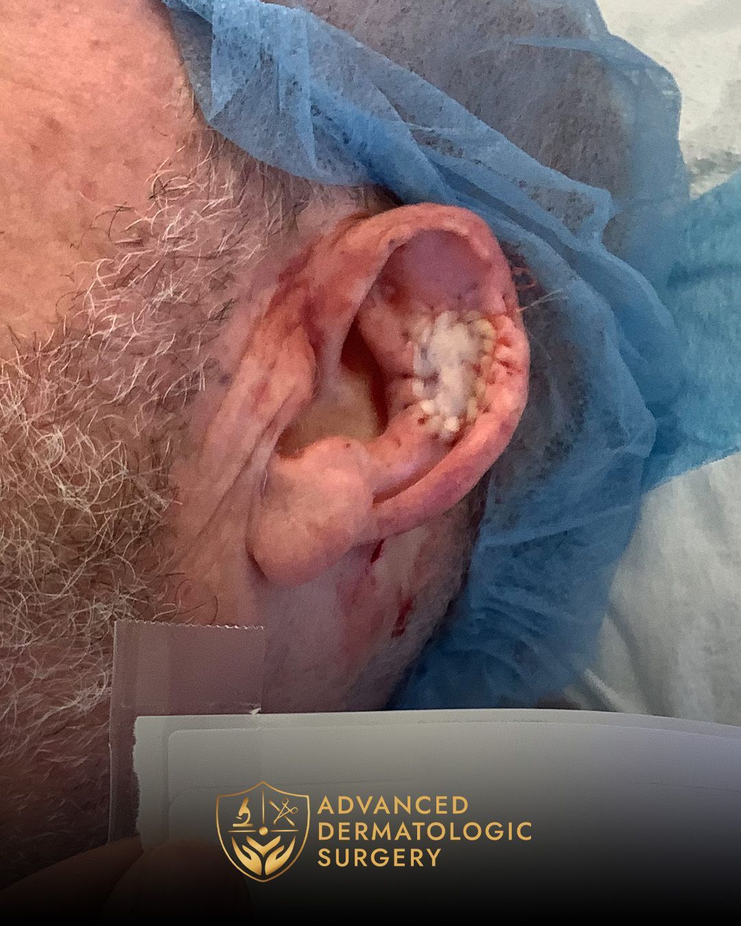 Close up of a post operative surgery on a man's ear for Mohs surgery at Advanced Dermatologic Surgery