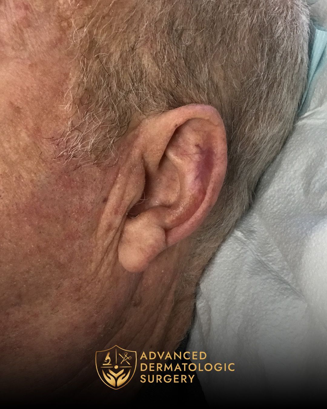 Close up of long term results on a man's ear after Mohs surgery at Advanced Dermatologic Surgery