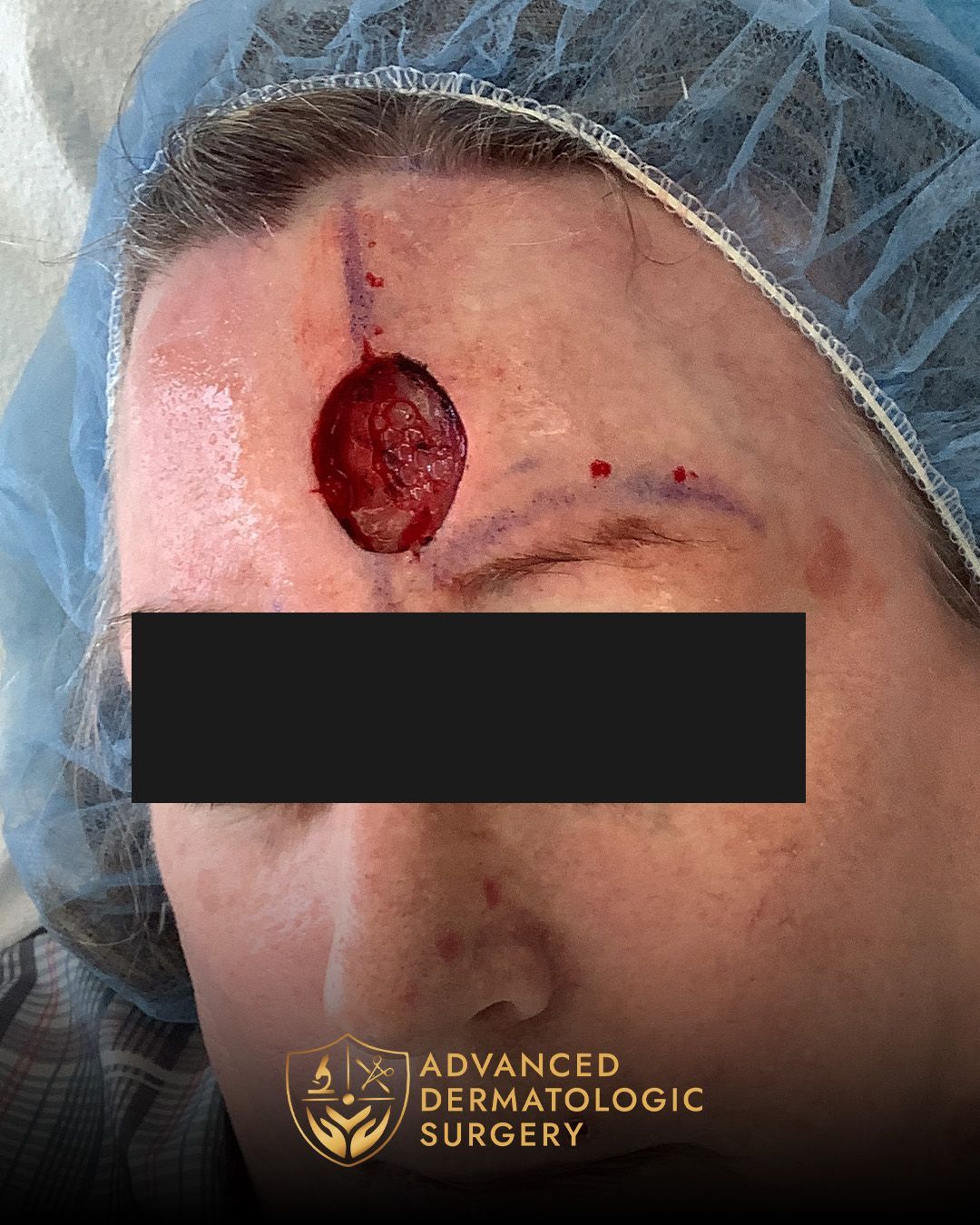 Close up of a pre operative surgery on a woman's forehead before Mohs surgery at Advanced Dermatologic Surgery