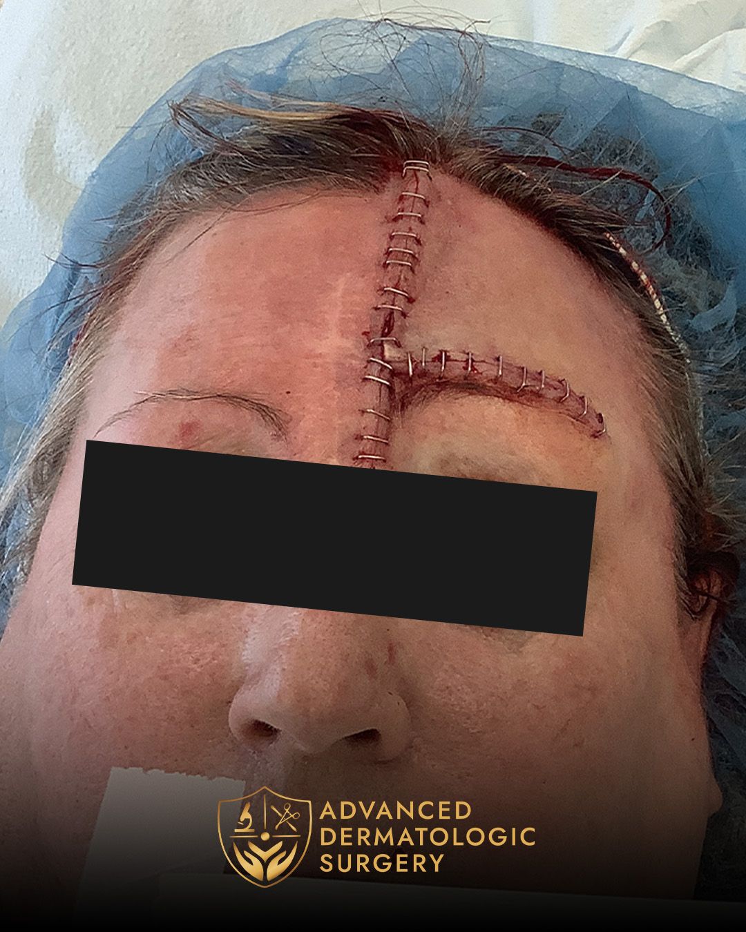 Close up of a post operative stitches on a woman's forehead during Mohs surgery at Advanced Dermatologic Surgery