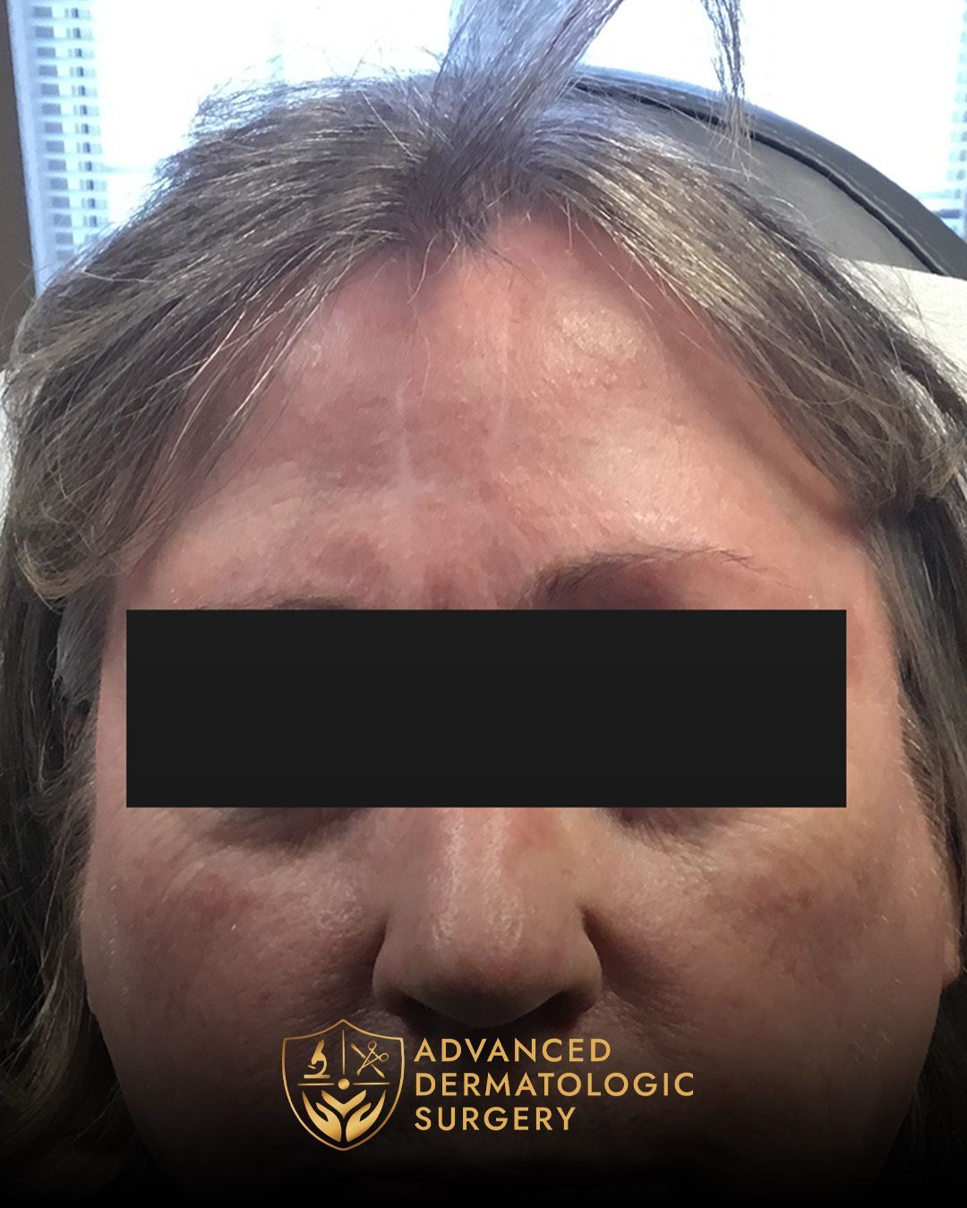 Close up of a long term results on a woman's forehead after Mohs surgery at Advanced Dermatologic Surgery