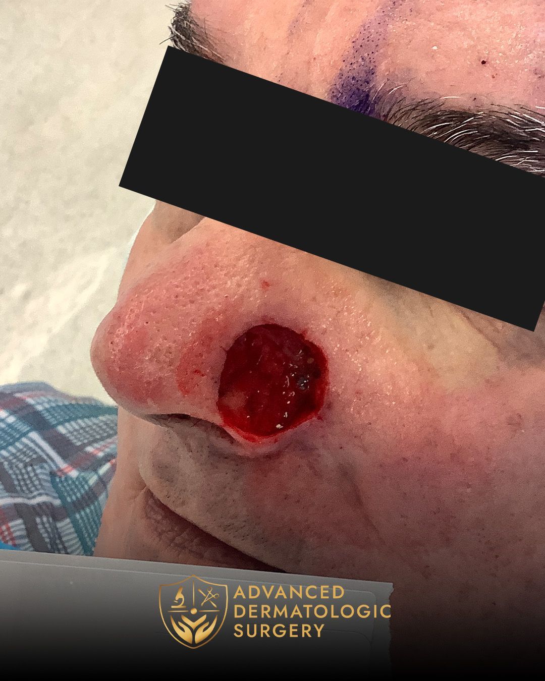 Close up of a pre operative surgery on a man's nose for Mohs surgery at Advanced Dermatologic Surgery