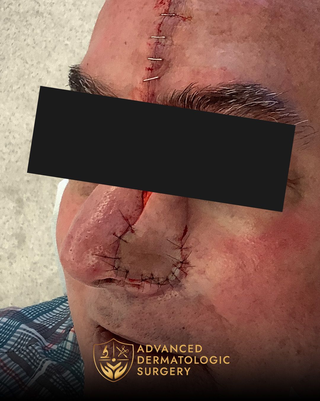 Close up of a post operative surgery on a man's nose for Mohs surgery at Advanced Dermatologic Surgery