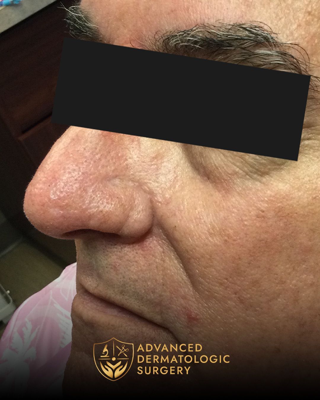 Close up of long term results on a man's nose after Mohs surgery at Advanced Dermatologic Surgery