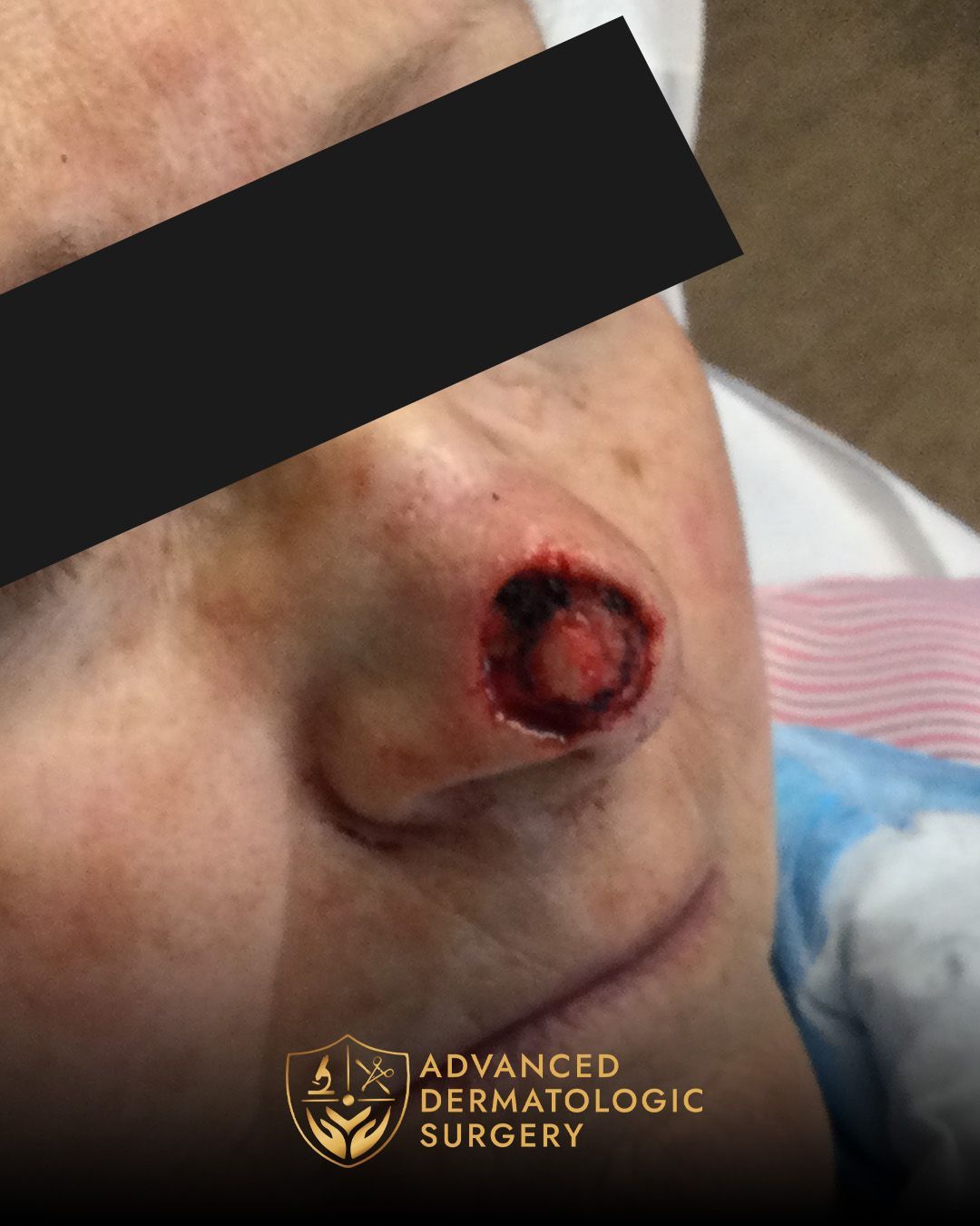 Close up of a pre operative surgery on a man's nose for Mohs surgery at Advanced Dermatologic Surgery