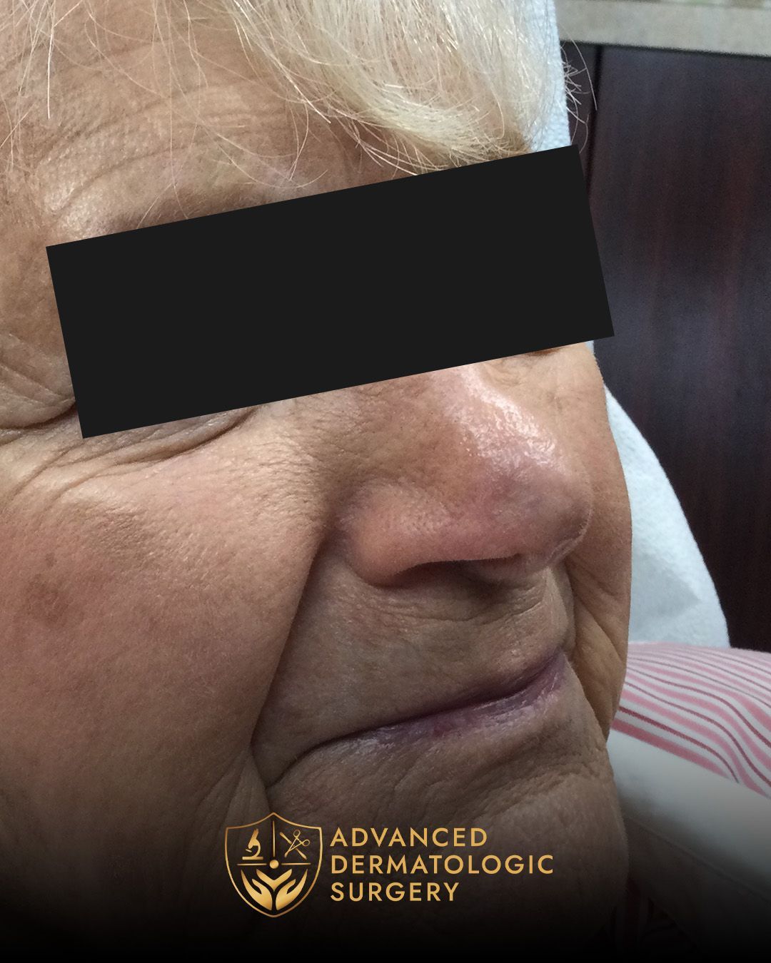Long-term results of Mohs surgery and Reconstruction at Advanced Dermatologic Surgery