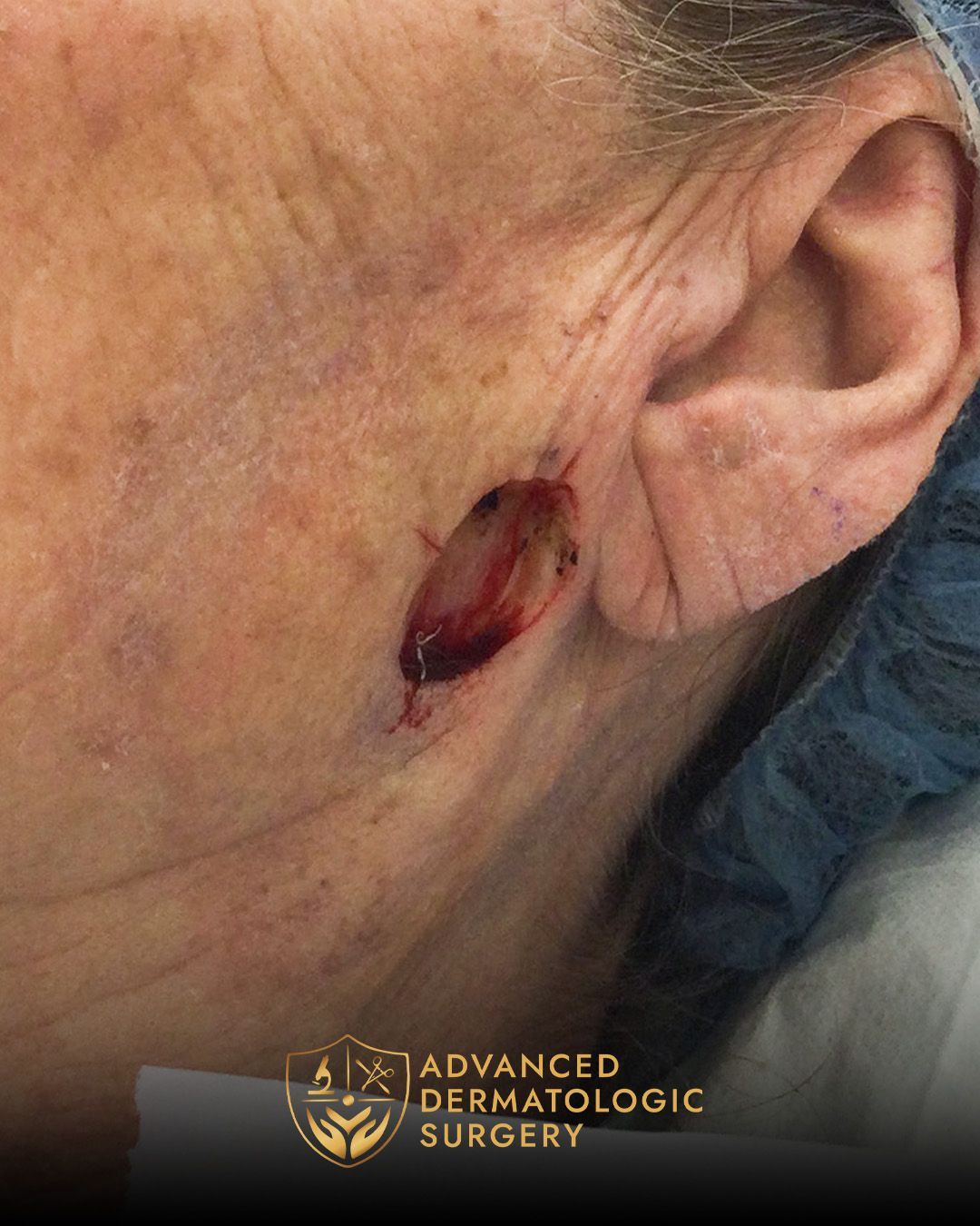 Close up of a pre operative surgery on a woman's jawline for Mohs surgery at Advanced Dermatologic Surgery