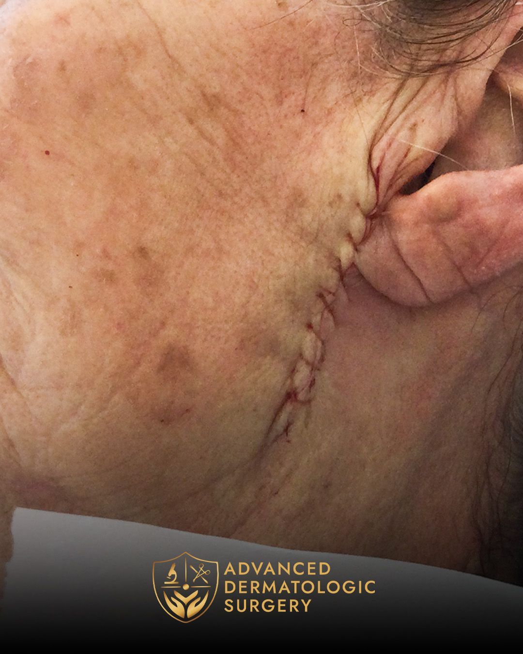 Close up of a post operative stitches on a woman's jawline for Mohs surgery at Advanced Dermatologic Surgery