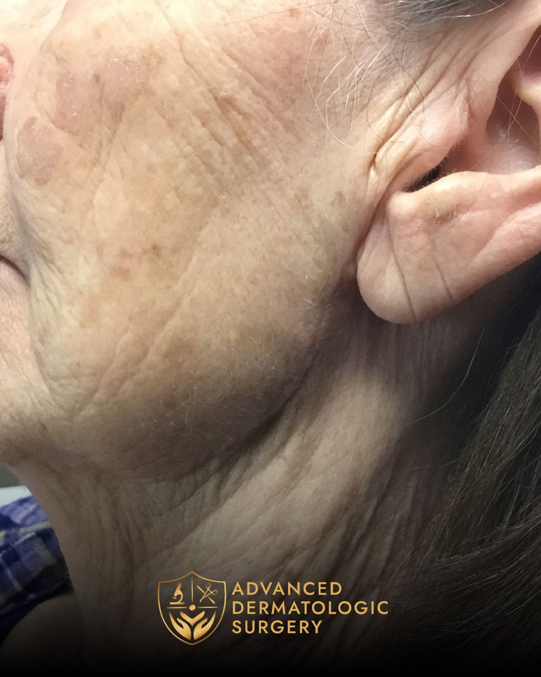 Close up of a long term results on a woman's jawline for Mohs surgery at Advanced Dermatologic Surgery