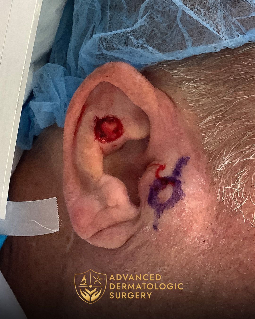 Close up of ear post mohs surgery