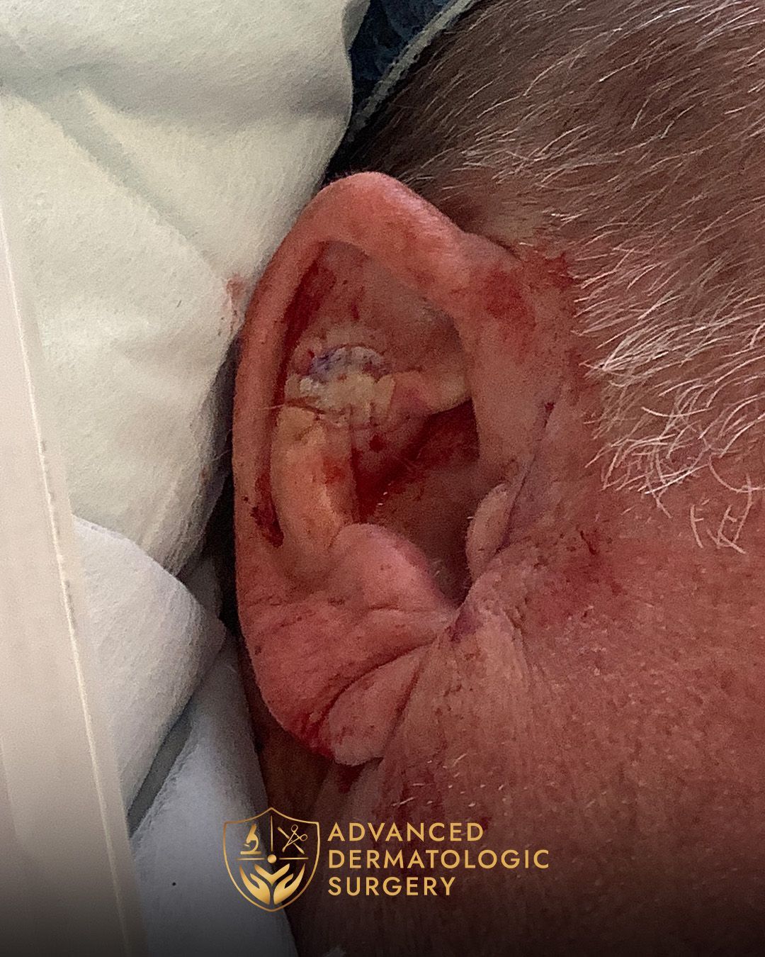 close up of ear after receiving surgery