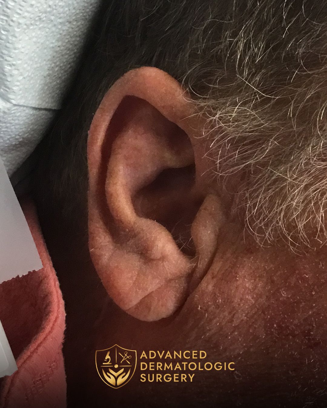 Close up of ear after fully healed from Mohs surgery
