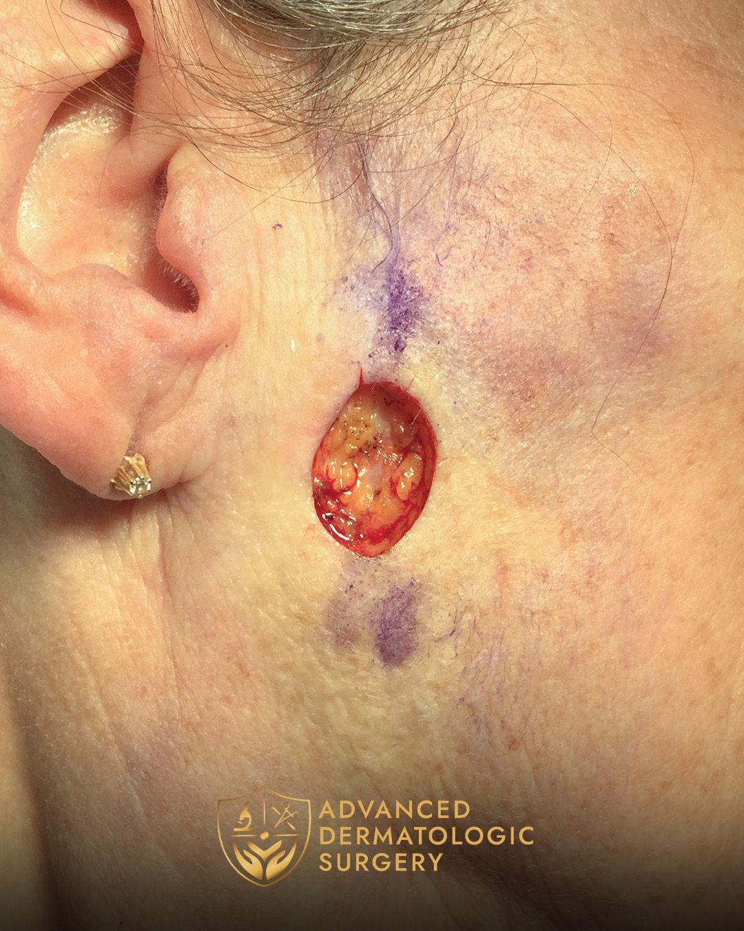 Close up of a mans jawline after receiving Mohs surgery