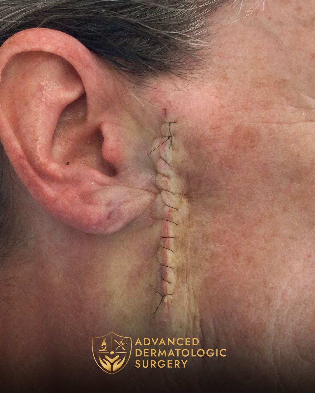 Close up of a mans jawline after reconstruction surgery