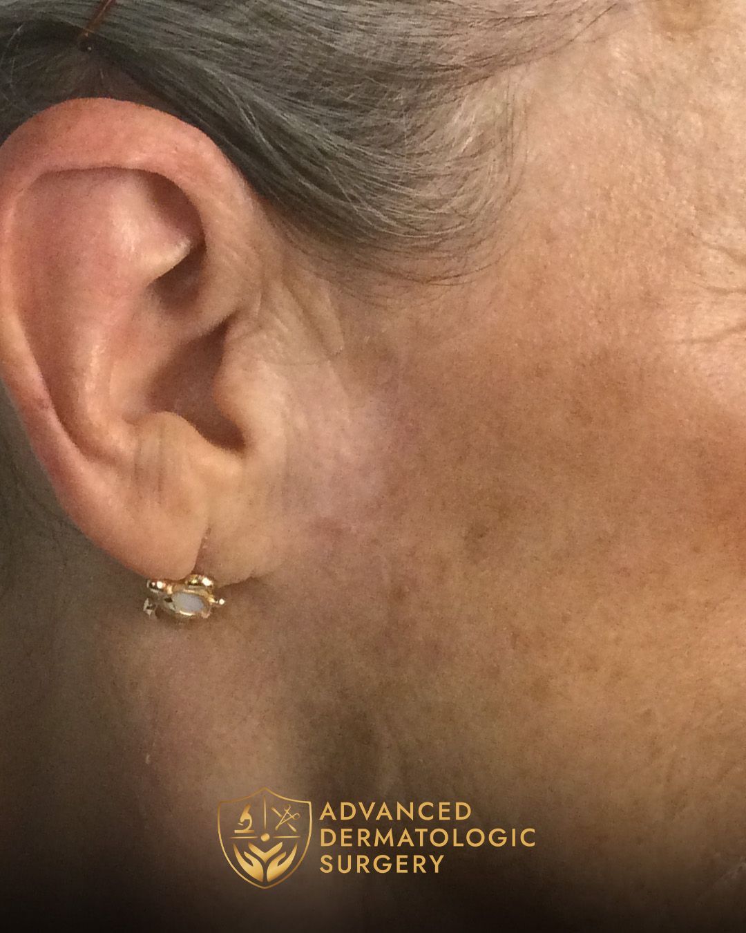 Close up of a fully healed jawline