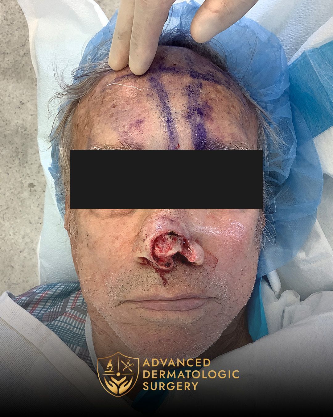 Reconstructive surgery after Mohs surgery on the nose at dvanced Dermatologic Surgery