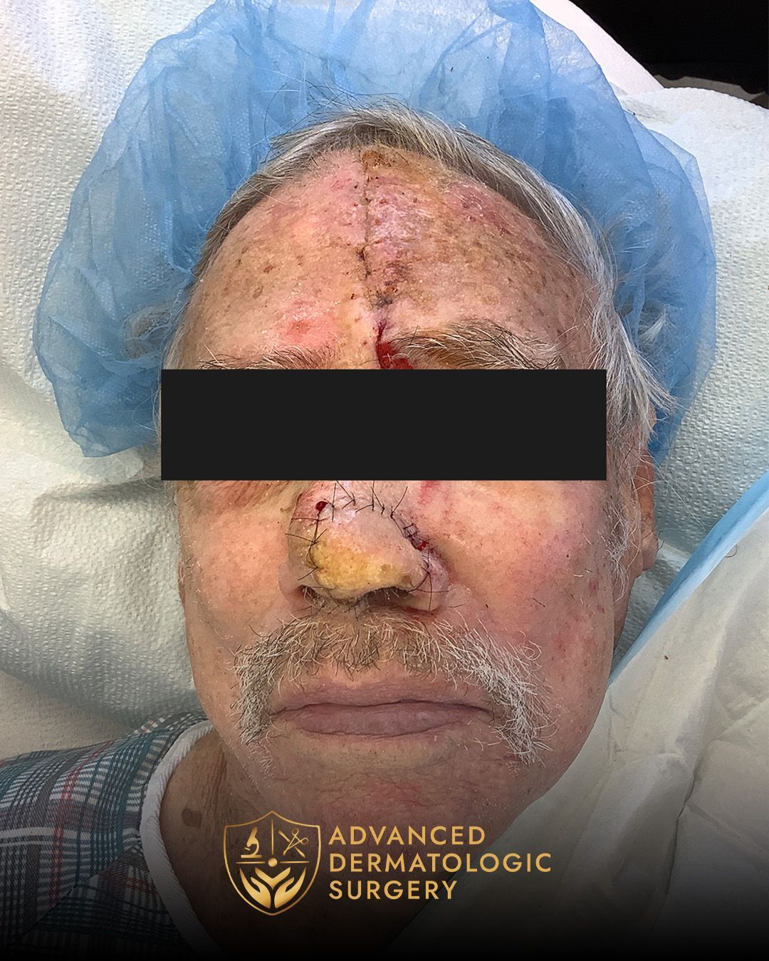 Reconstructive surgery on the nose after Mohs surgery  at Advanced Dermatologic Surgery