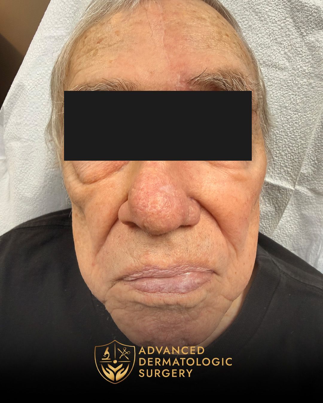 Long-term results of Mohs and Reconstructive surgery at dvanced Dermatologic Surgery