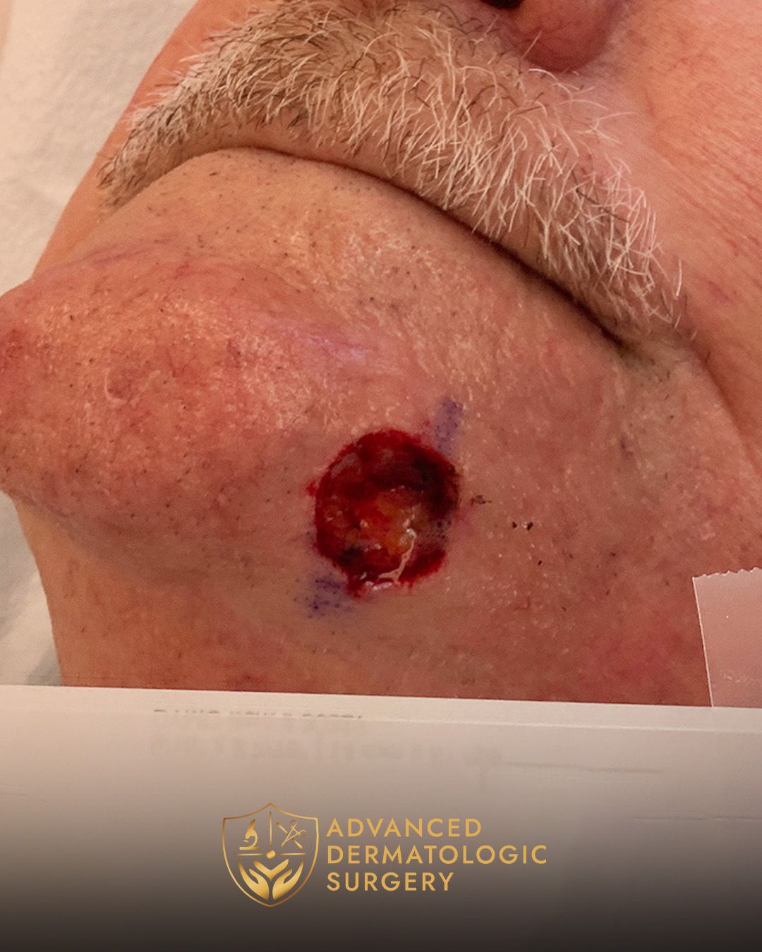 Close up of a mans chin after receiving Mohs surgery