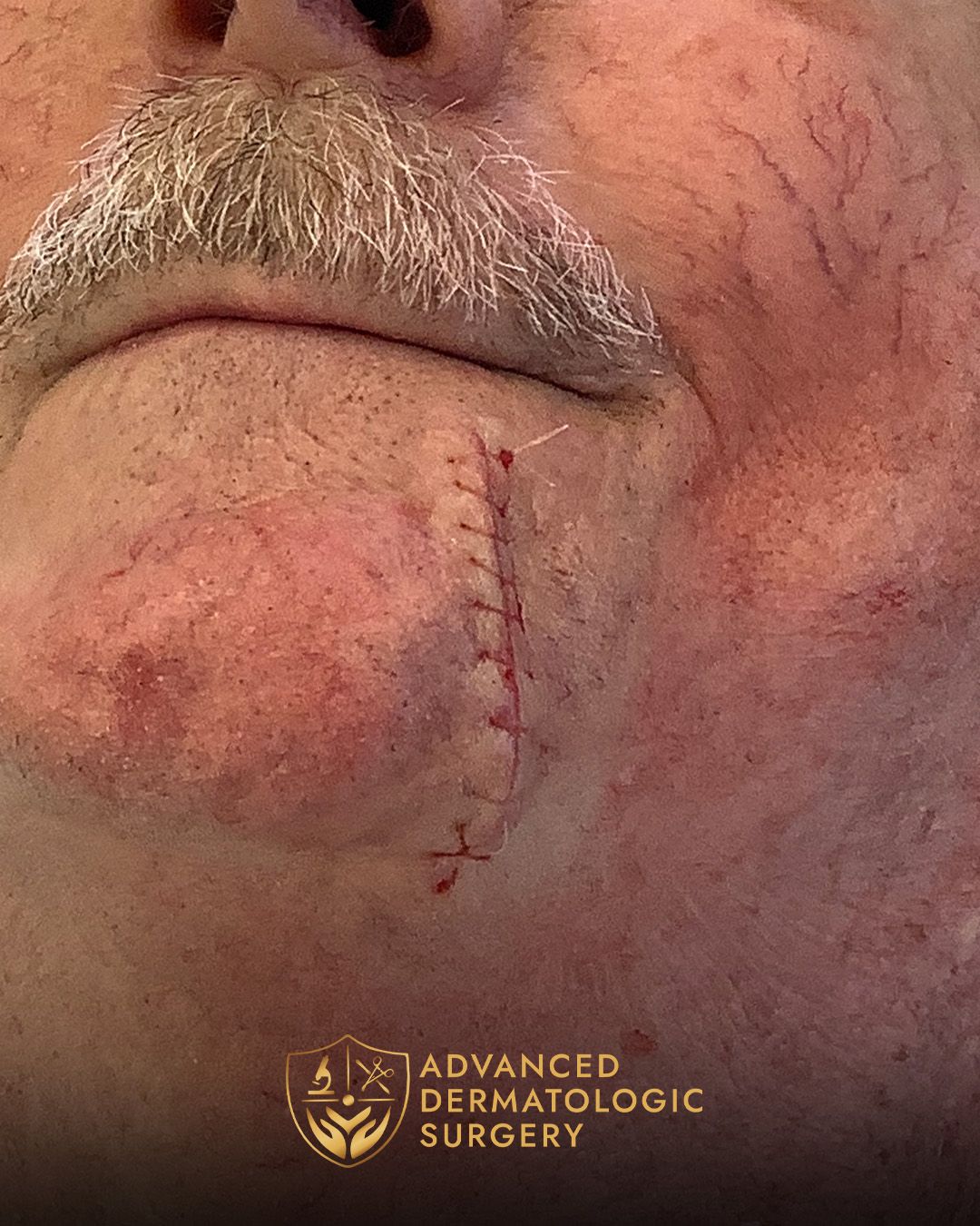 Close up of a mans chin after reconstruction surgery