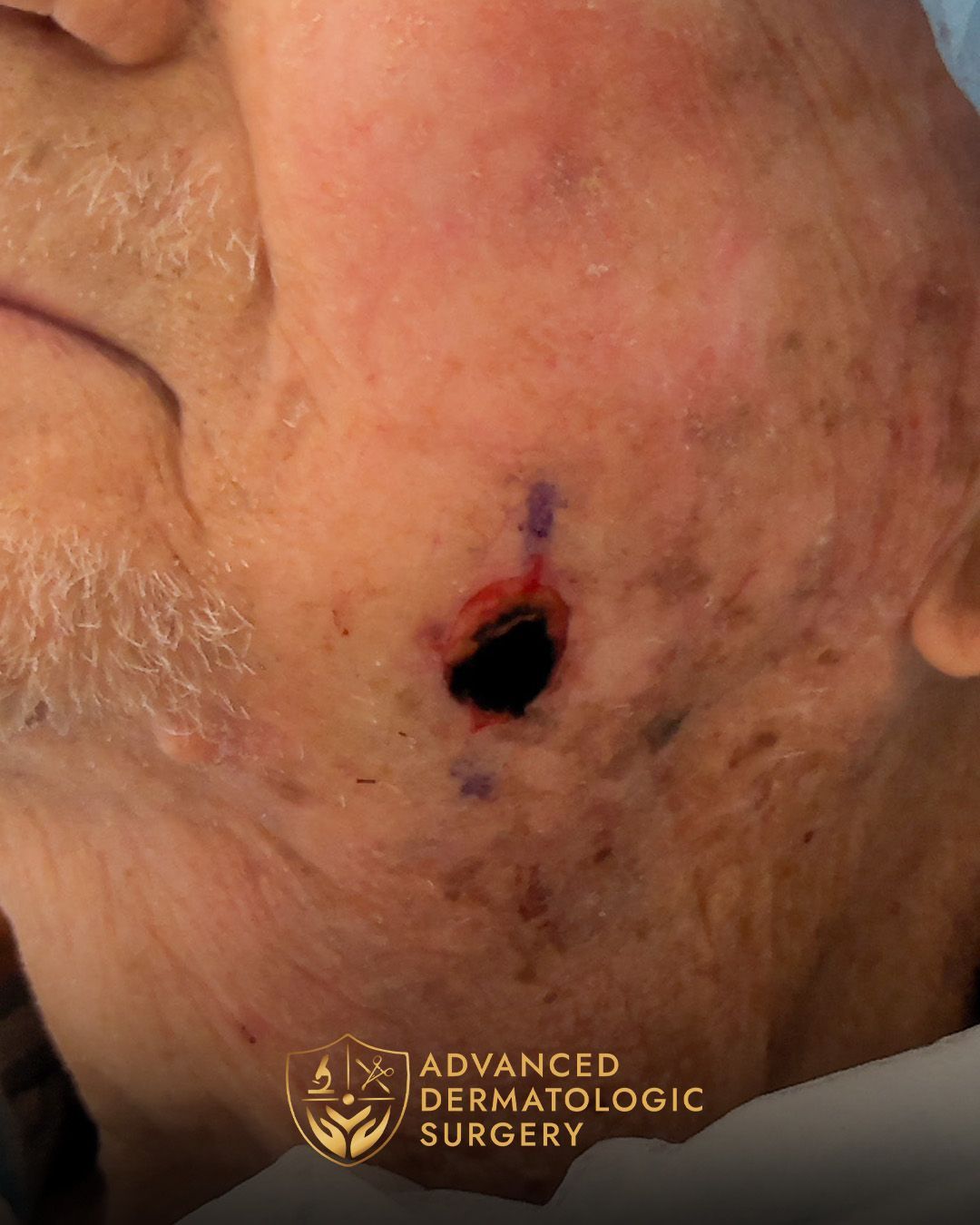 Close up of a mans jawline after receiving Mohs surgery