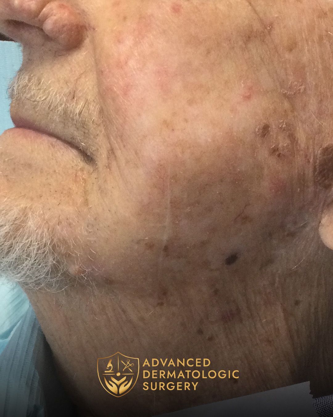Close up of a fully healed jawline