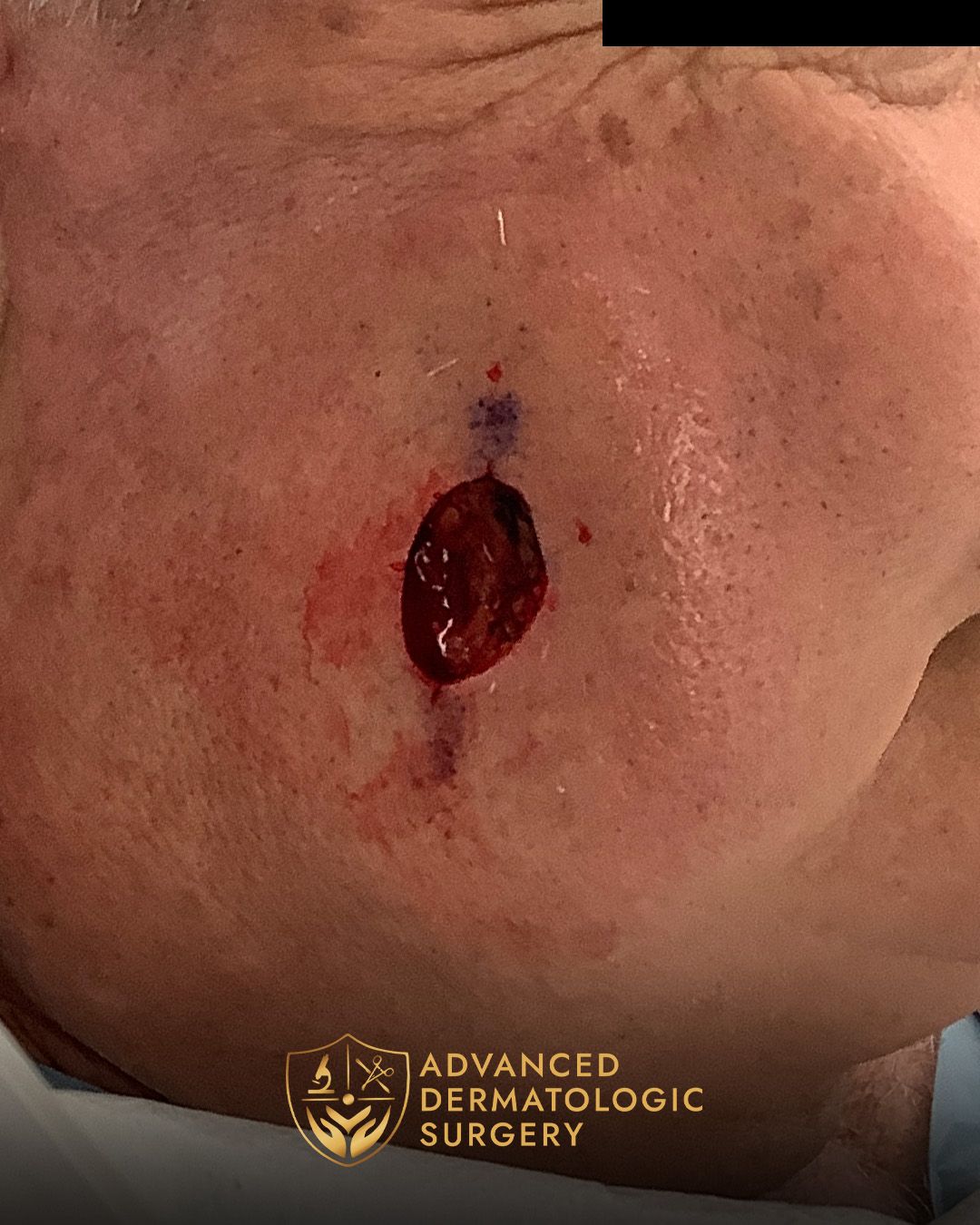Close up of a man's cheek after receiving Mohs surgery