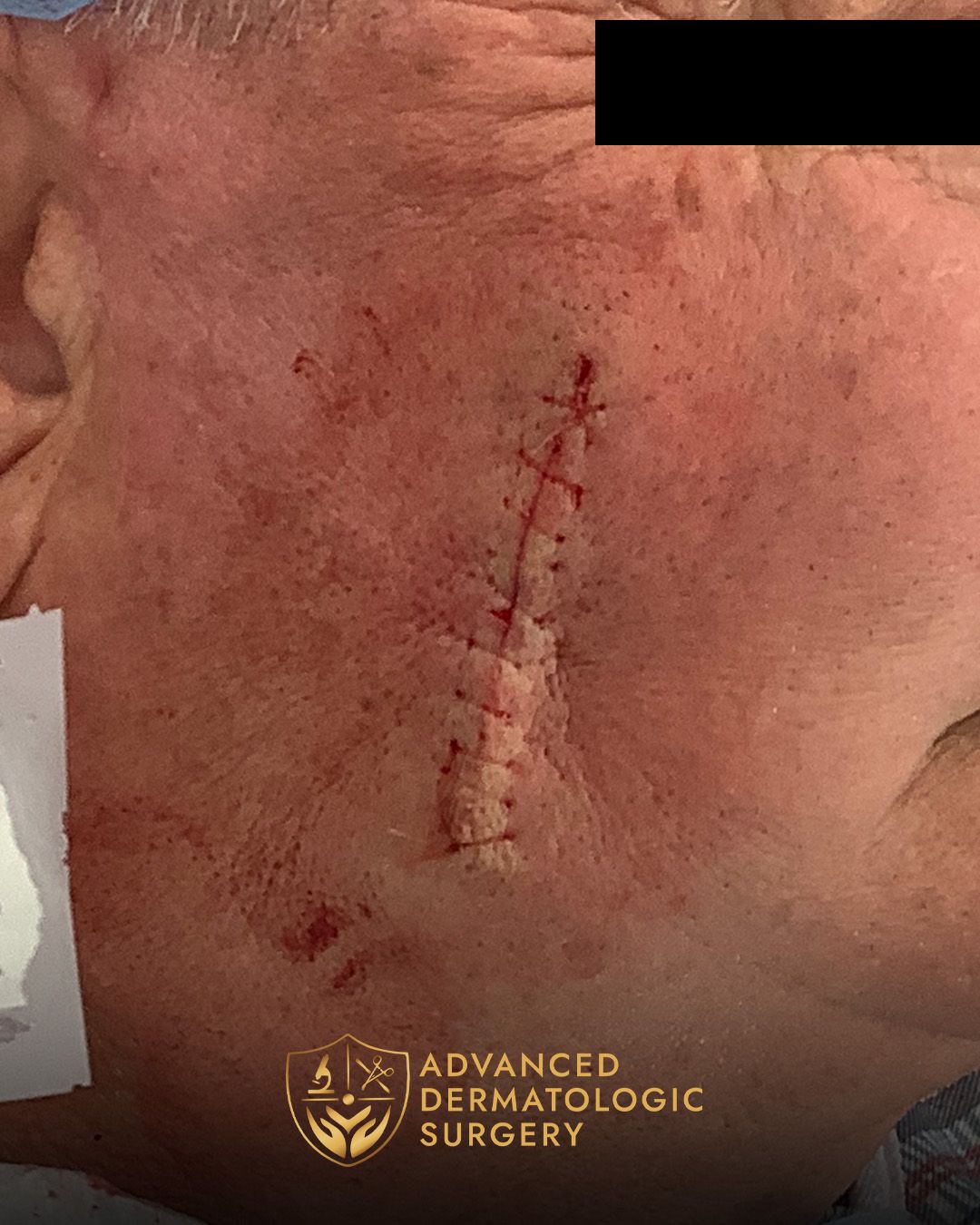 Close up of a mans cheek after reconstruction surgery