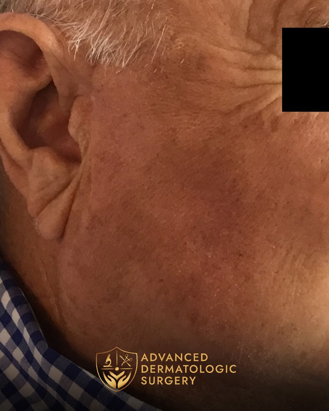 Fully healed cheek after Mohs surgery