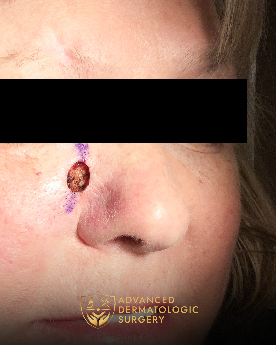 Post Mohs surgery photo of a woman's cheek