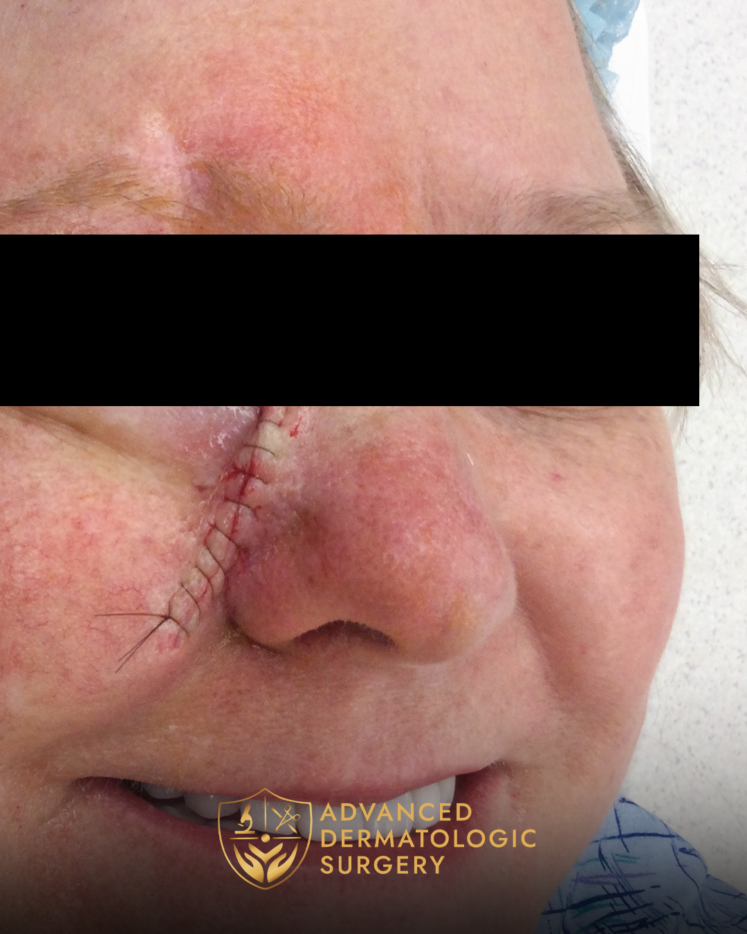 A woman's cheek after receiving reconstructive surgery