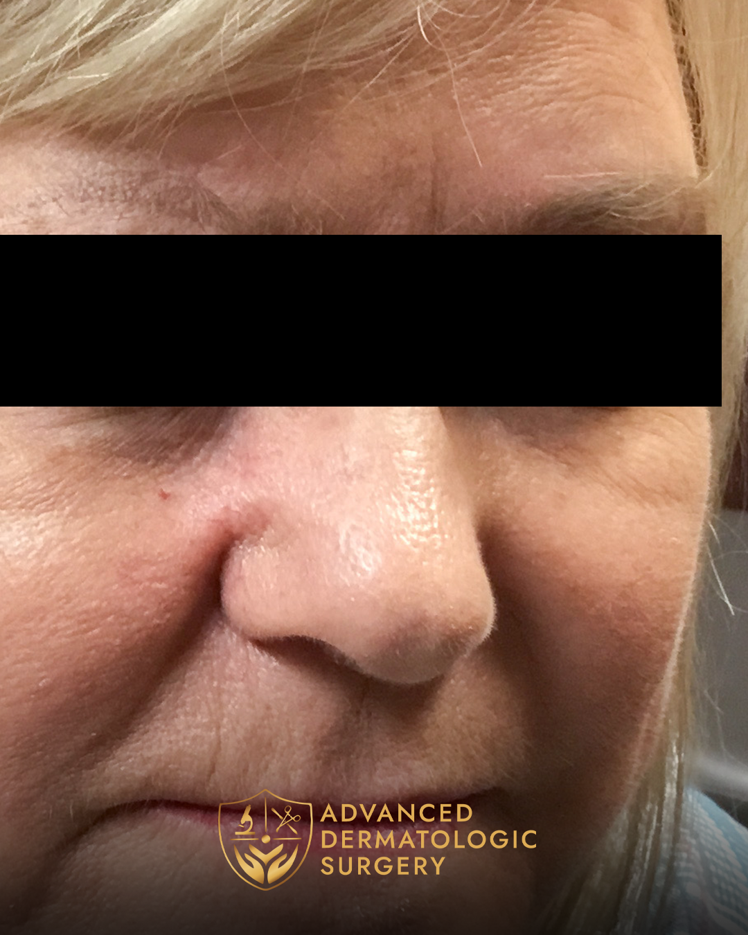Fully healed results of a cheek mohs surgery