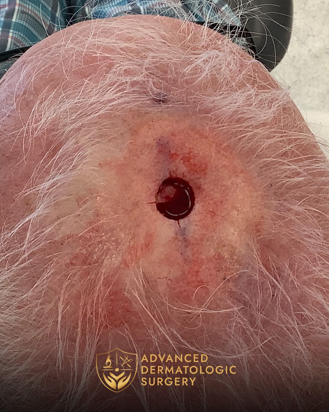 Close up of a man's scalp after receiving Mohs surgery