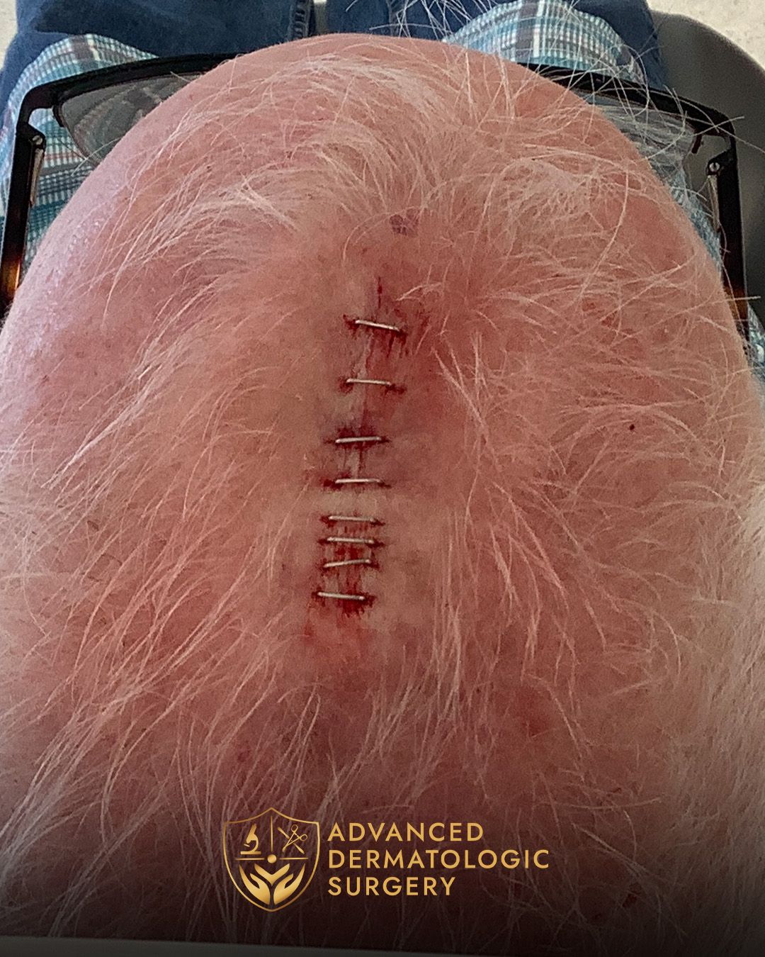 Close up of the reconstruction stitches on a man's scalp