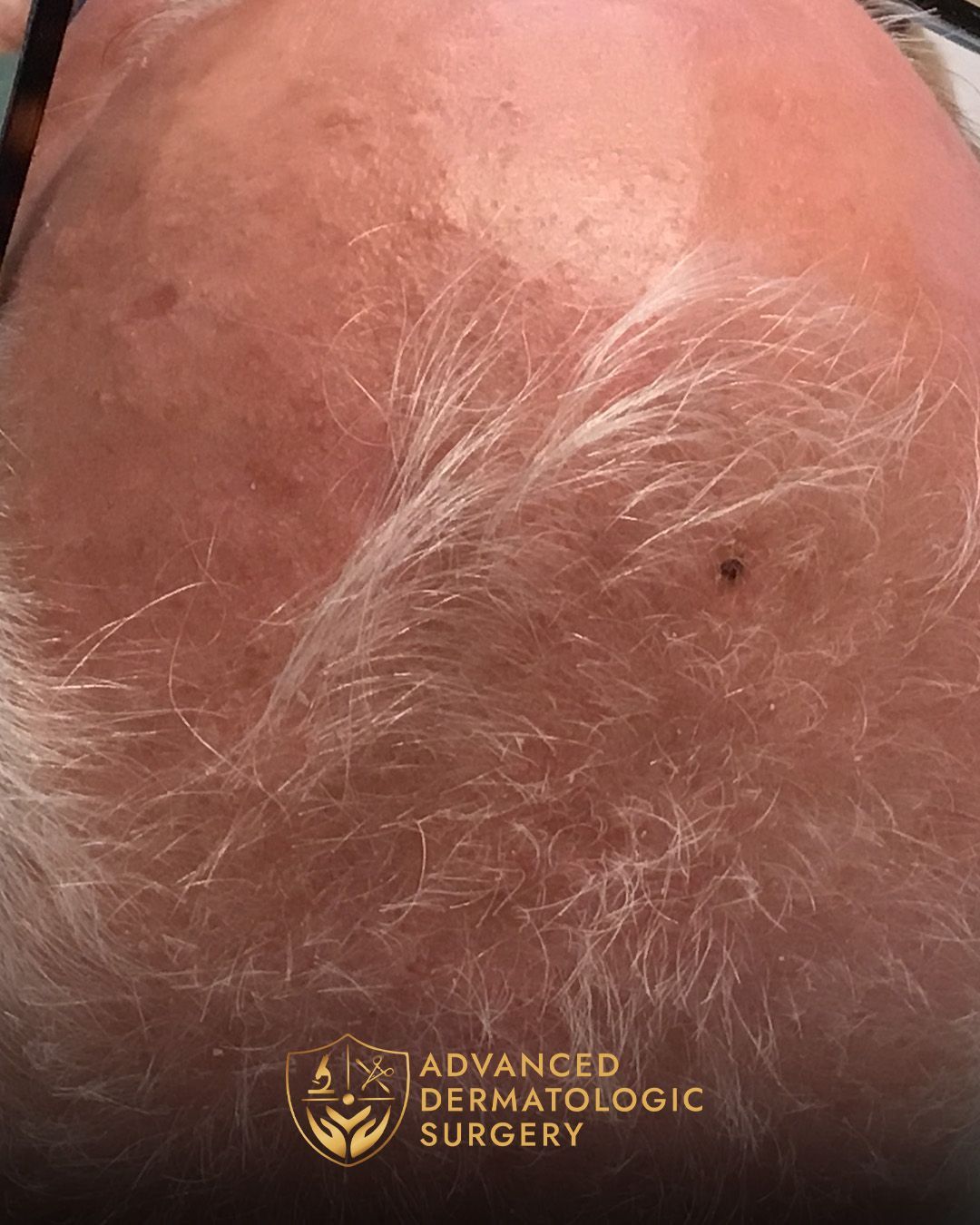 Healed results of a man's scalp 