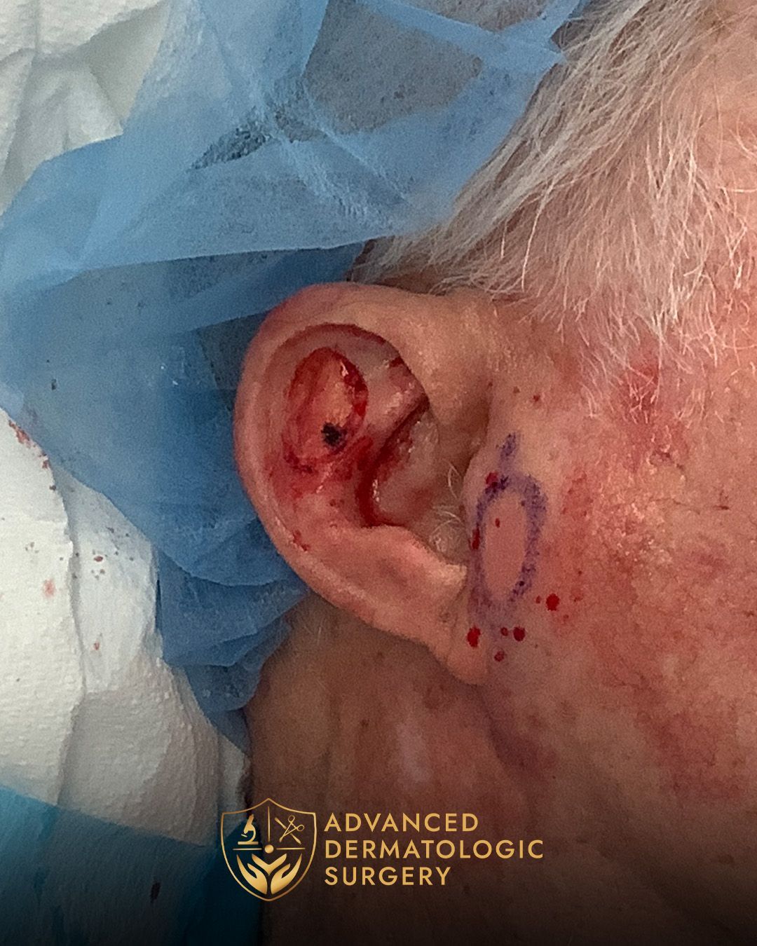 Close up of a man's ear after Mohs surgery