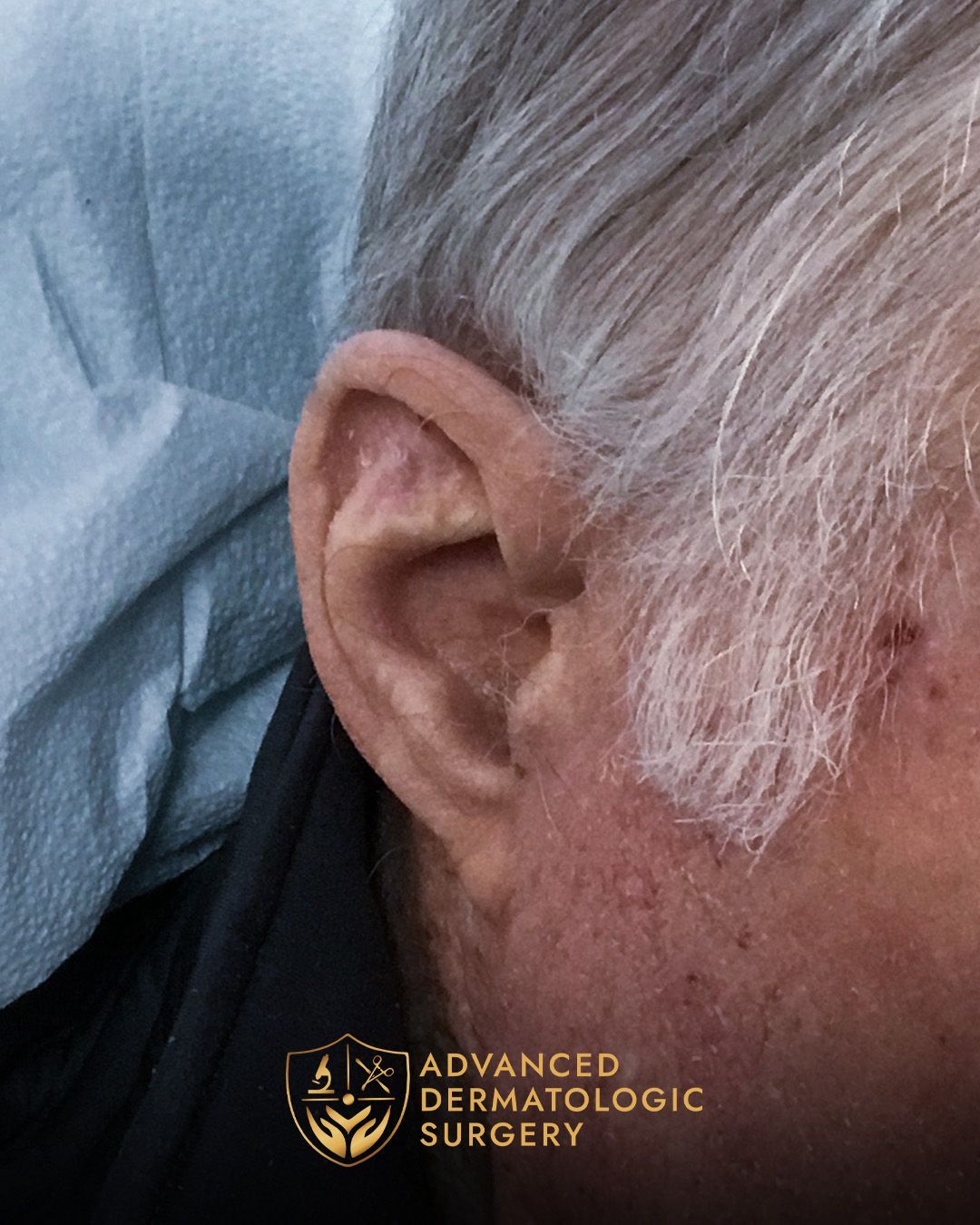 Close up of a man's fully healed ear after Mohs surgery