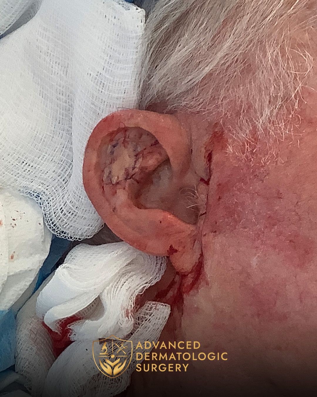 Close up of a man's ear after reconstructive surgery