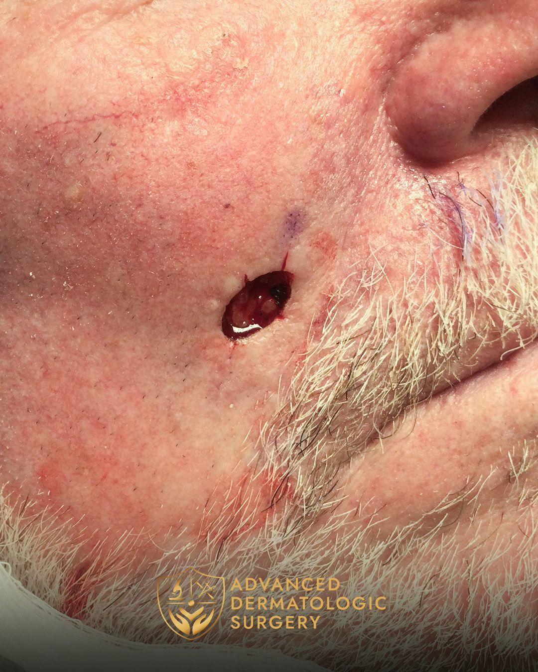 Close up of a man's cheek after Mohs surgery