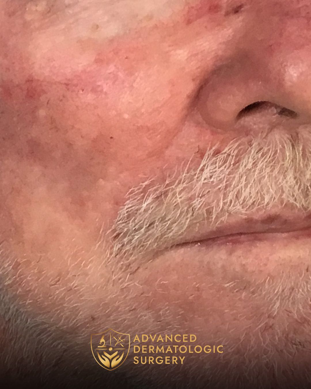 A man's fully healed cheek after surgery