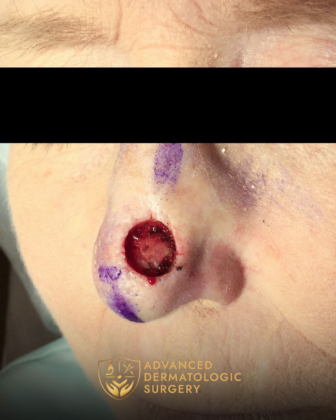 Close up of a woman's nose after Mohs surgery