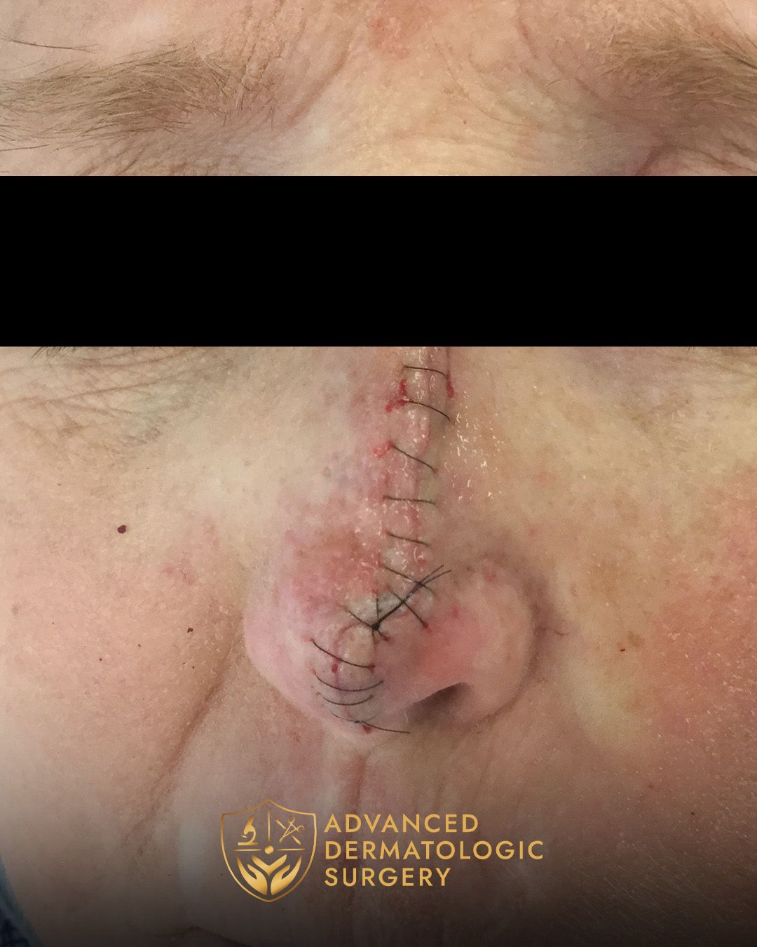 Close up of a woman's nose after reconstructive surgery