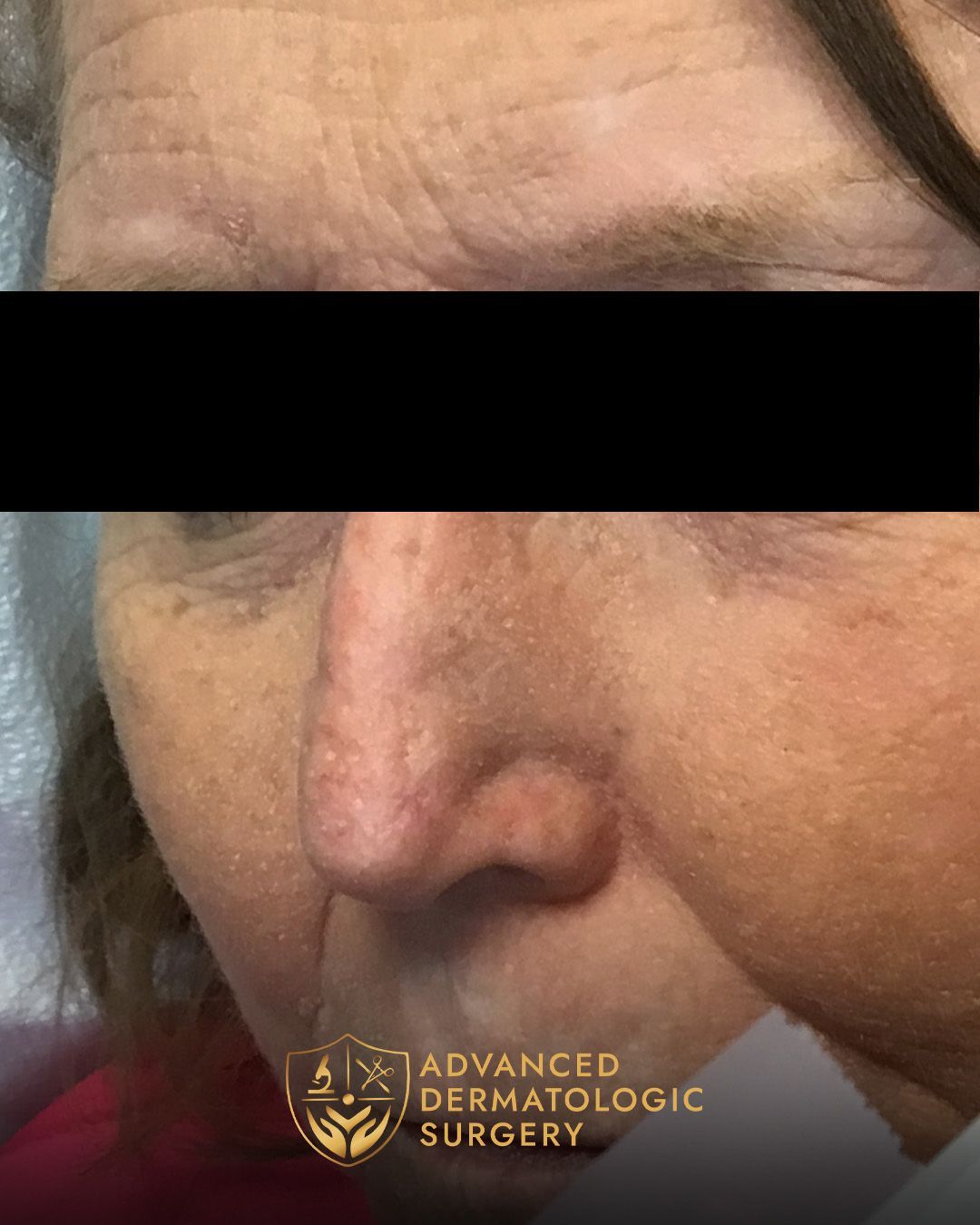 Close up of a fully healed nose after Mohs surgery