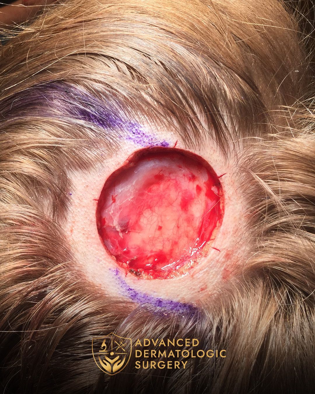 Close up of a woman's scalp after Mohs surgery