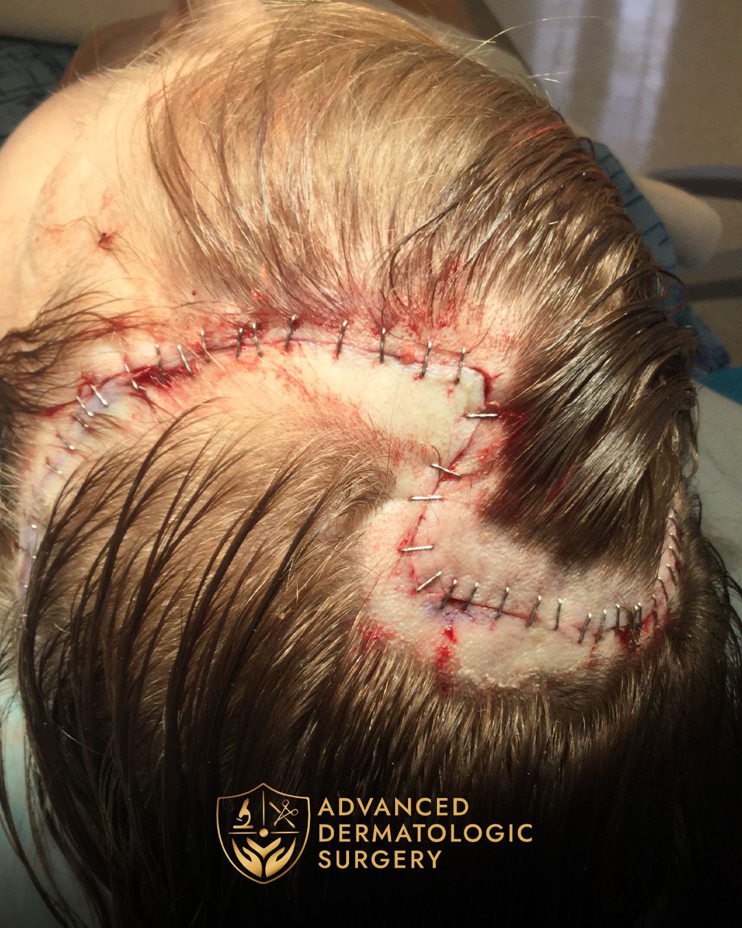 Close up of a woman's scalp after reconstruction surgery