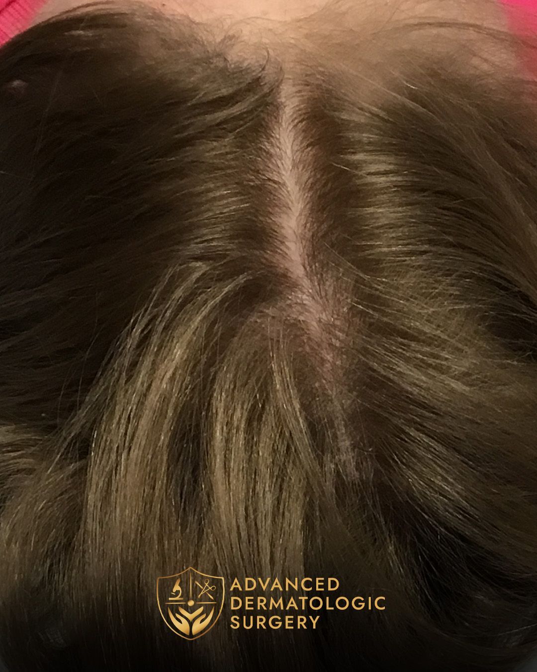 Fully healed scalp close up 
